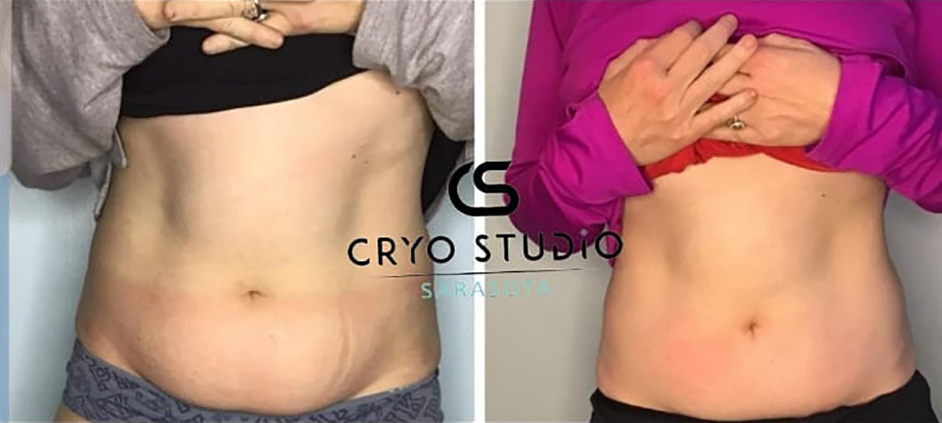 What is Cryoslimming? - Cryostudio Sarasota